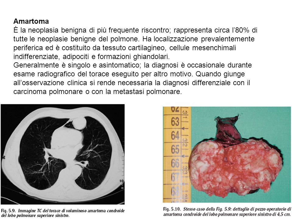 metastasi polmonari da carcinoma mammario sintomi