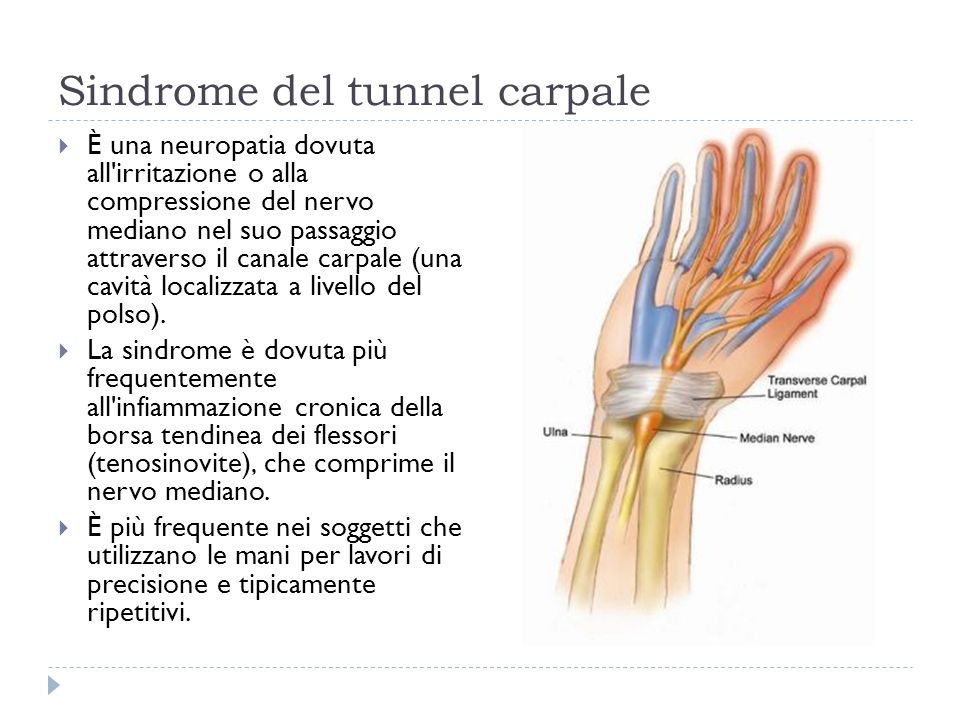 Sindrome del tunnel carpale È una neuropatia dovuta all irritazione o alla compressione del nervo mediano nel suo passaggio attraverso il canale carpale (una cavità localizzata a livello del polso).
